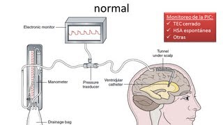 Hipertensión Endocraneana  FISIOPATOLOGIA  GRUPO ATLAS [upl. by Ennayr]