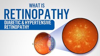 What is Retinopathy  Diabetic retinopathy  Hypertensive retinopathy [upl. by Hachman]