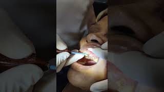 Gingivectomy RFcauterycrownlengthening [upl. by Siouxie]