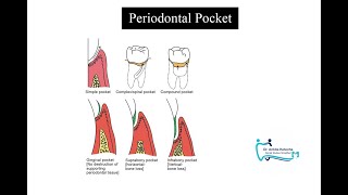 PERIODONTAL POCKET TERMINOLOGIES CLASSIFICATION FEATURES SITE SPECIFICITY HEALING LESION [upl. by Ydualc]