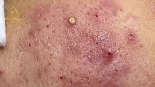 Treatment of pustules and inflammatory acne 84  Loan Nguyen [upl. by Nelleus]