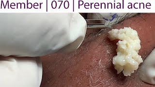 Acne Treatment Huong Da Nang 070  Perennial acne [upl. by Grata]