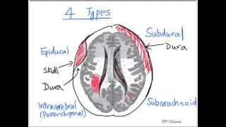 Intracranial Bleed  Part 1 [upl. by Jadda]