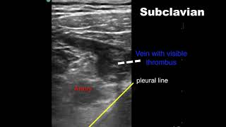 Subclavian DVT Associated with PICC Line [upl. by Tewell]