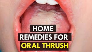 How to Treat Candida at Home  5 Home Remedies for Oral Thrush [upl. by Amelia]