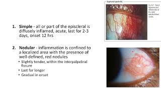 EPISCLERITIS AND SCLERITIS [upl. by Elsbeth]