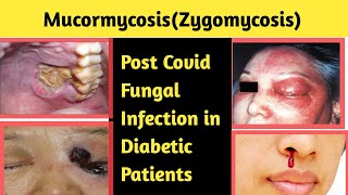 Mucormycosis Zygomycosis  Fungal Infection Post Covid [upl. by Osyth]