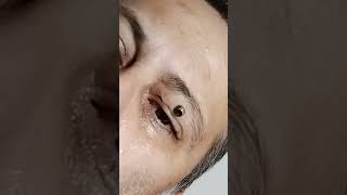 Botfly Maggot Removal spa doctor satisfying pimple removal [upl. by Eirehs]