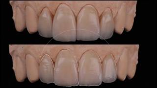 preperation less anterior esthetic veneers platinum foil [upl. by Atinnod]