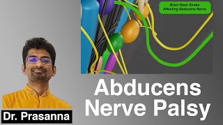 Abducens Nerve Palsy [upl. by Hseham]