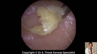 Top Biggest Ear Wax Removal 107  Ear wax Extraction  Dr S Thouk Earwax Specialist [upl. by Alyakim]