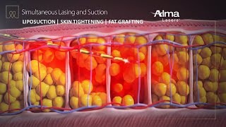 Liposuction Skin Tightening amp Fat Grafting  Lipo Life by Alma Lasers Medical Device 3D Animation [upl. by Narat]