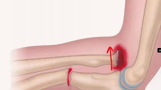 Monteggia fracture dislocation  NEET Ortho shots  ORTHO for medical students  Named fractures [upl. by Boyce]