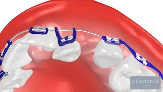 Oque é Ortodontia Como funciona um Aparelho Ortodôntico ortodontia invisalign clinicajin [upl. by Warthman]