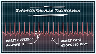 SVT  SUPRAVENTRICULAR TACHYCARDIA  Arrhythmias  Causes symptoms ECG  Stable amp Unstable Patient [upl. by Ratep837]