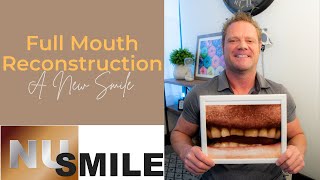 Full Mouth Reconstruction amp Crowns Helped Revert the Results of Constant Teeth Grinding [upl. by Llemij]