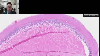 Appendiceal Mucocele vs Lowgrade appendiceal mucinous neoplasm LAMN [upl. by Mahla803]