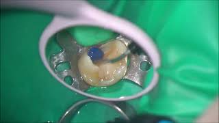 part I Access opening of upper right 2nd molar [upl. by Haissem]