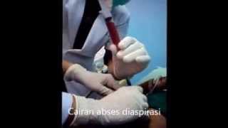 Tutorial aspiration of liver abscess 1 [upl. by Drexler]