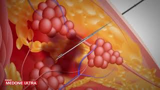 MedOne Ultra  Aguja Biopsia Trucut automática Marca Medax origen Italia [upl. by Ebehp]