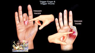 Trigger Finger amp Trigger Thumb  Everything You Need To Know  Dr Nabil Ebraheim [upl. by Ultann]