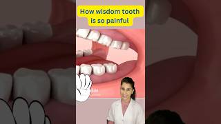 Wisdom teeth Pain  Wisdom tooth Removal shorts viralvideo dental trending toothpain wisdom l [upl. by Anaizit986]