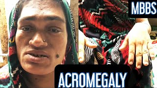 Acromegaly Growth Hormone Disorder mbbs medicine neetpg neet next aiims inicet [upl. by Yllak]