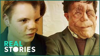 The Ugly Face of Disability Hate Crime Adam Pearson Documentary  Real Stories [upl. by Beckett]