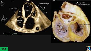 Echocardiographic Anatomy Part 3 Apical Four Chambers A4C [upl. by Darce99]