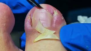 Dig Out Ingrown Toenails FAST with These Simple Steps [upl. by Ellen]