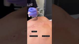 Mole Removal with Radiofrequency at StudioMD moleremovaltreatment [upl. by Staci198]