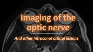 Imaging of the optic nerve [upl. by Neehcas]