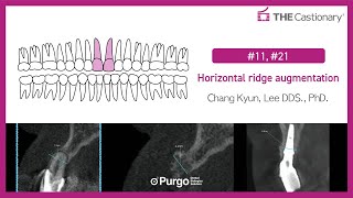 11 21 Horizontal ridge augmentation [upl. by Panthia]