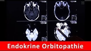 Endokrine Orbitopathie  MRT Darstellung  by Radiologie TV [upl. by Faxen]