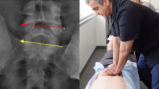 Low Back Pain Tilted Pelvis and Tailbone HELPED Dr Rahim [upl. by Ellennej274]