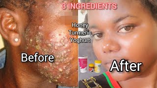 How to Remove Pimples Dark SpotsAcneFirst  3 HoneyTurmeric and Yoghurt beauty [upl. by Ttenrag46]