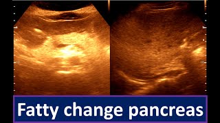 Moderately diffuse fatty infiltration of the Liver  Fatty change pancreas [upl. by Genna]