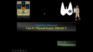 Ultrasound Case 9  Thyroid Nodule TIRADS V Papillary carcinoma [upl. by Bogoch]