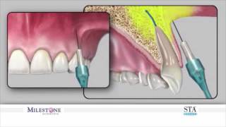 The Wand® STA Instrument  Supraperiosteal Buccal Infiltration [upl. by Cristiona]