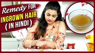 Ingrown Hair Removal At Home  Remedy For Ingrown Hair In Hindi  DIY  Ingrown Hair Treatment [upl. by Dowzall]