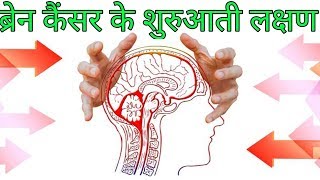 ब्रैन कैंसर के लक्षणbrain cancer ke lakshanbrain cancer symptoms hindi [upl. by Eatnuahc]