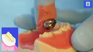 Stainless Steel Crown Technique for a Primary Molar Tooth [upl. by Mandal]