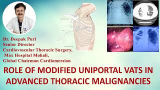 ROLE OF MODIFIED UNIPORTAL VATS IN ADVANCED THORACIC MALIGNANCIES  DR Deepak Puri  Max Hospital [upl. by Yanehc471]