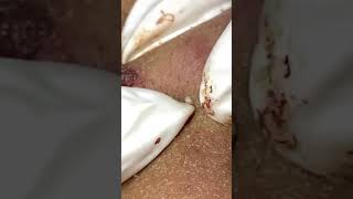 Big Cystic Acne Blackheads Extraction Blackheads amp Milia Whiteheads Removal Pimple Popping [upl. by Burt]