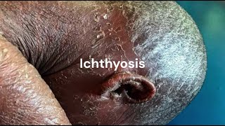 What is Ichthyosis  Ichthyosis Treatment in Homeopathy [upl. by Lodi]