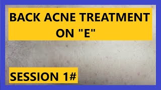 Back ACNE Treatment on quotEquot SESSION 1 [upl. by Ima]