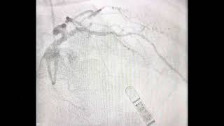 Complex ostial LAD stenosis How to tackle [upl. by Atirabrab759]