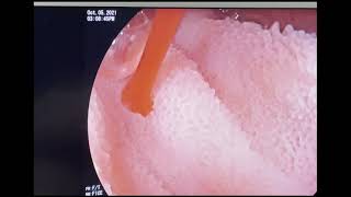 Bleeding small bowel Dieulofoy Lesion found during Double Balloon Enteroscopy [upl. by Oralla]