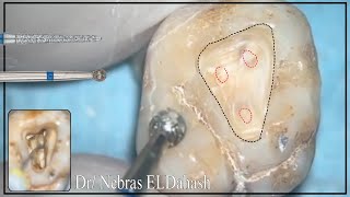 Upper Molar Access cavity preparation [upl. by Anitsenre]