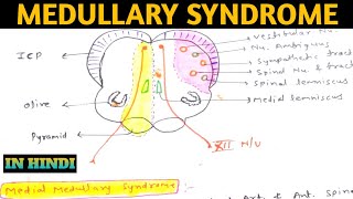 Medullary Syndrome  Medial Medullary Syndrome  Lateral Medullary Syndrome  Wallenberg Syndrome [upl. by Aimal]